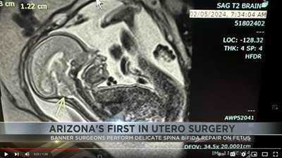 az-first-utero-surgery